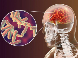 Três Lagoas confirma novo caso de meningite meningocócica e Saúde reforça medidas de prevenção