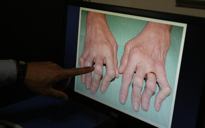 Saúde de Três Lagoas confirma primeiro caso de Chikungunya de 2019