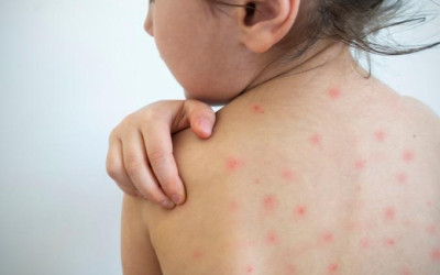 SARAMPO - Segunda etapa da Campanha de Vacinação começa hoje, e é destinada às pessoas de 20 a 29 anos