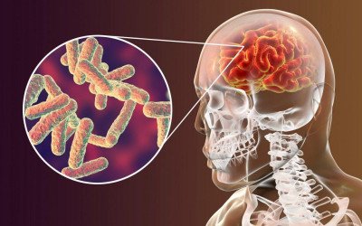 Três Lagoas confirma novo caso de meningite meningocócica e Saúde reforça medidas de prevenção