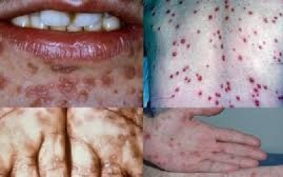 Saúde alerta população sobre cuidados e prevenção da epidemia de sífilis