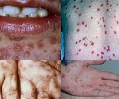 Saúde alerta população sobre cuidados e prevenção da epidemia de sífilis