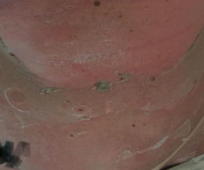 ALERTA: Após bronzeamento em clínica, campo-grandense sofre queimaduras por todo corpo