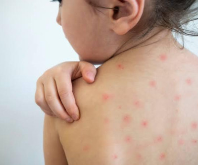 Três Lagoas inicia busca ativa de vacinação contra o sarampo e convoca famílias para proteger crianças