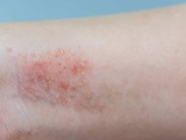 Dermatite atópica impacta pele, sono e autoestima: saiba como tratar