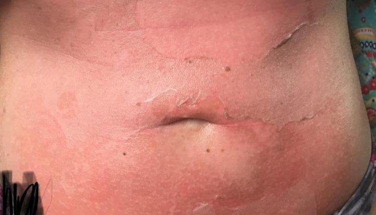 ALERTA: Após bronzeamento em clínica, campo-grandense sofre queimaduras por todo corpo ALERTA: Após bronzeamento em clínica, campo-grandense sofre queimaduras por todo corpo