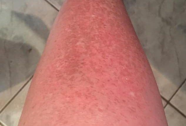 ALERTA: Após bronzeamento em clínica, campo-grandense sofre queimaduras por todo corpo ALERTA: Após bronzeamento em clínica, campo-grandense sofre queimaduras por todo corpo