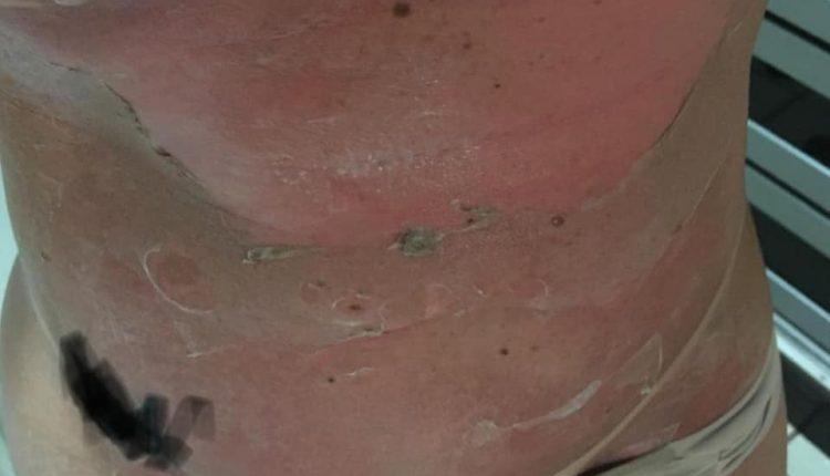 ALERTA: Após bronzeamento em clínica, campo-grandense sofre queimaduras por todo corpo ALERTA: Após bronzeamento em clínica, campo-grandense sofre queimaduras por todo corpo