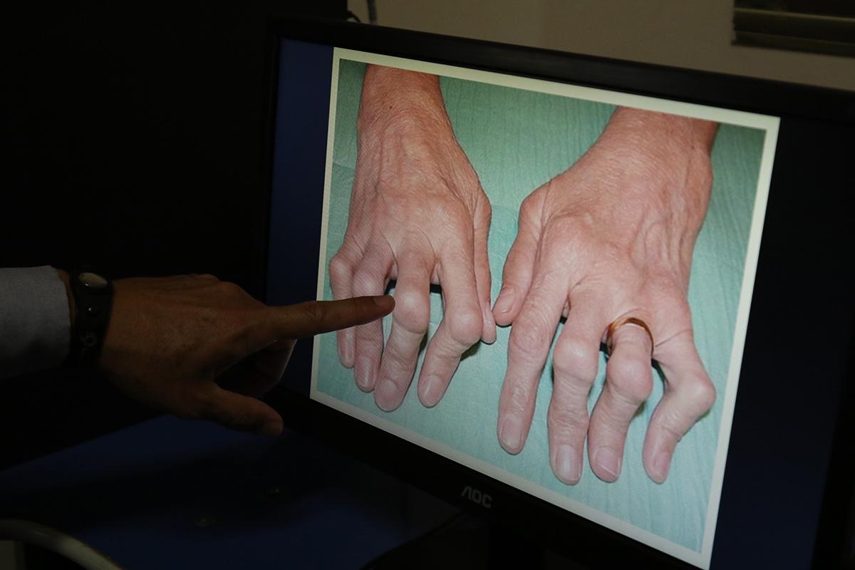 Saúde de Três Lagoas confirma primeiro caso de Chikungunya de 2019 Saúde de Três Lagoas confirma primeiro caso de Chikungunya de 2019