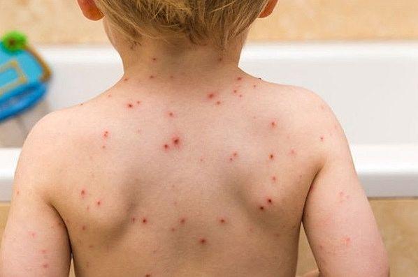 Saúde intensifica vacinação contra o sarampo nas Unidades Básicas de Saúde de Três Lagoas Saúde intensifica vacinação contra o sarampo nas Unidades Básicas de Saúde de Três Lagoas