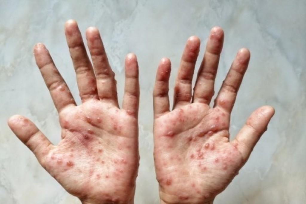 MONKEYPOX – Seis casos em investigação são descartados e três novos são notificados como suspeitos MONKEYPOX – Seis casos em investigação são descartados e três novos são notificados como suspeitos