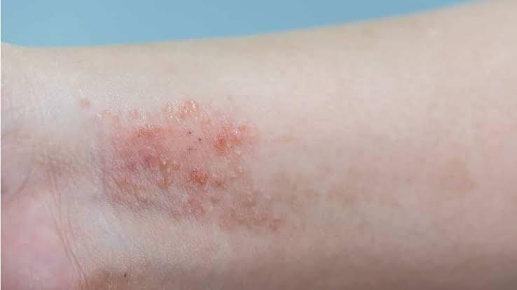 Dermatite atópica impacta pele, sono e autoestima: saiba como tratar