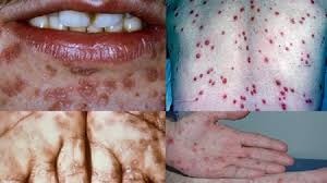 Saúde alerta população sobre cuidados e prevenção da epidemia de sífilis Saúde alerta população sobre cuidados e prevenção da epidemia de sífilis